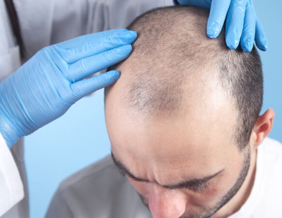 Hair Transplant Big Fue image